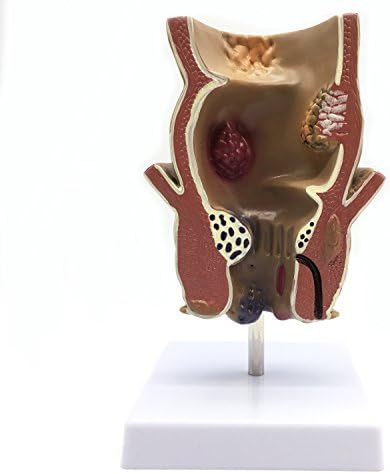 Medical Human haemorrhoids Model Anatomy for Science Classroom Study Display and Patient Education Teaching Medical Model - Image 2