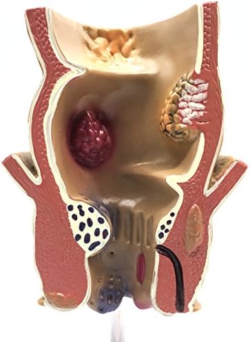Medical Human haemorrhoids Model Anatomy for Science Classroom Study Display and Patient Education Teaching Medical Model - Image 3